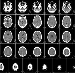 Как снимок головного мозга может выявить признаки тяжелого РС